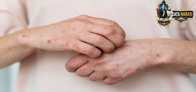 Dokter Meninggal Karena Campak Masalahnya Bukan Virusnya